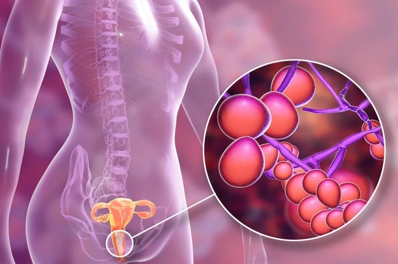 Ilustrace fibroidů v ženském ústrojí