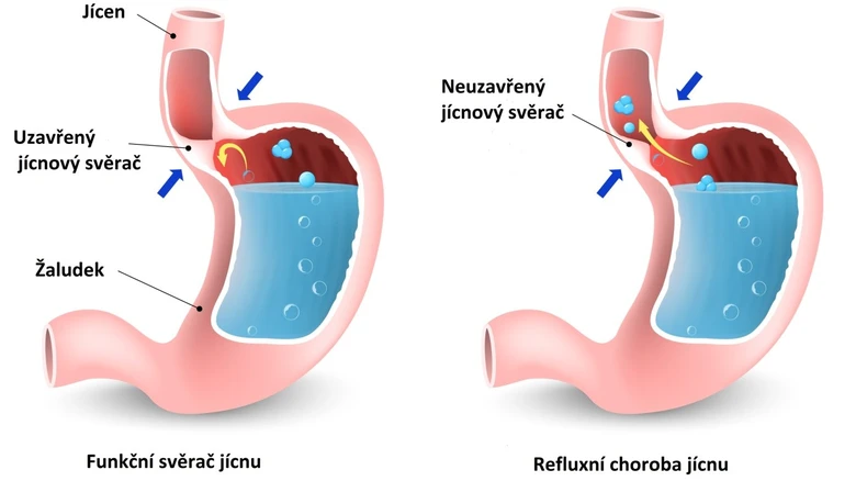 Porovnání funkčního a nefunkčního jícnového svěrače při refluxu