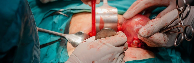 Chirurgický zákrok při abdominální hysterektomii s odhalenými orgány.