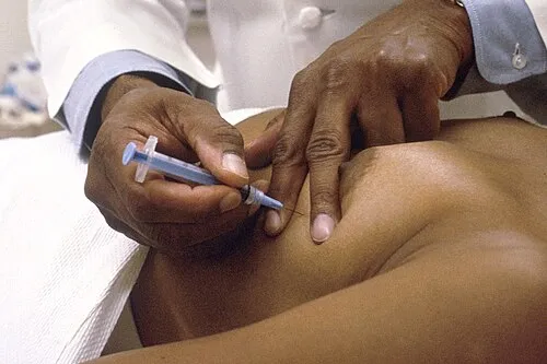 Lékař provádí biopsii jehlicí aspirací na kůži pacienta.