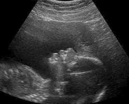 Fetal ultrasound scan