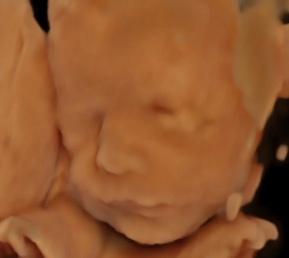 Třírozměrný ultrazvukový snímek obličeje nenarozeného dítěte.