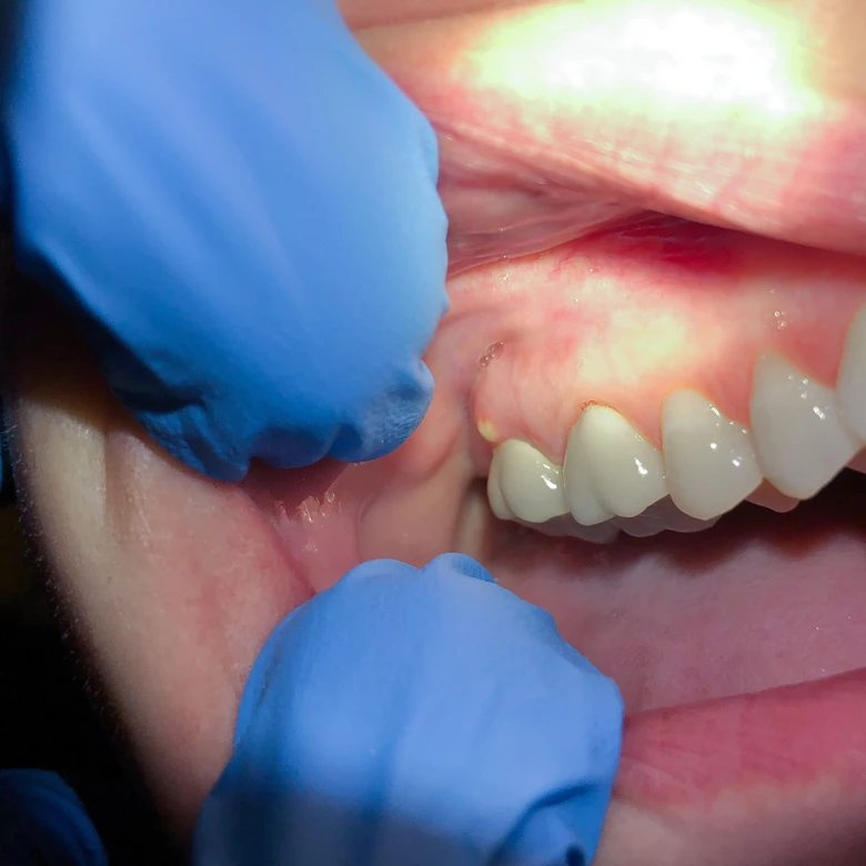 Zvětšená dásň s rukama v modrých latexových rukavicích