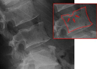 Schmorl's node spine x-ray