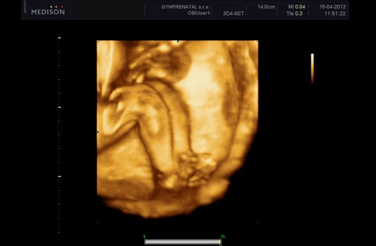 Fetal ultrasound scan