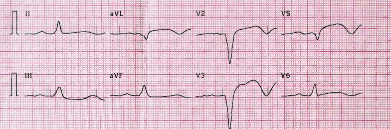 Elektrokardiogram s vlnami a kompletními vedením pro diagnostiku.