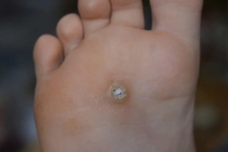 Plantar wart on foot sole