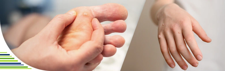 Plantární bradavice na patě a ruce pro diagnostiku.