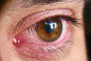 Human eye with conjunctivitis symptoms