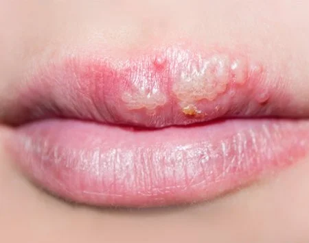 Blistery kožní infekce na rtech způsobená virem herpes.