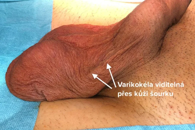 Varikokéla viditelná přes kůži šourku na mužském genitálu.