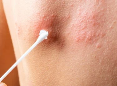 Vata tampon se aplikuje na zarudlou kůži s infekcí.