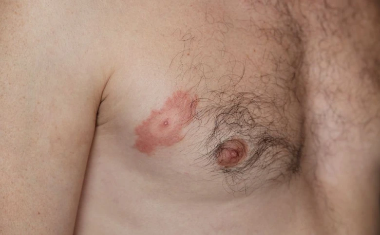 Červená flek po klíštěti na hrudi muže.