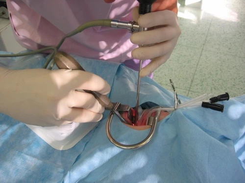 Zobrazení chirurgického zákroku při adenotomii s použitím nástrojů.